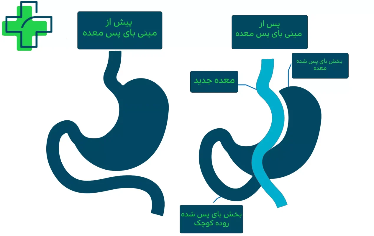 عمل بای پس معده در اصفهان نحوه عمل بای پس معده