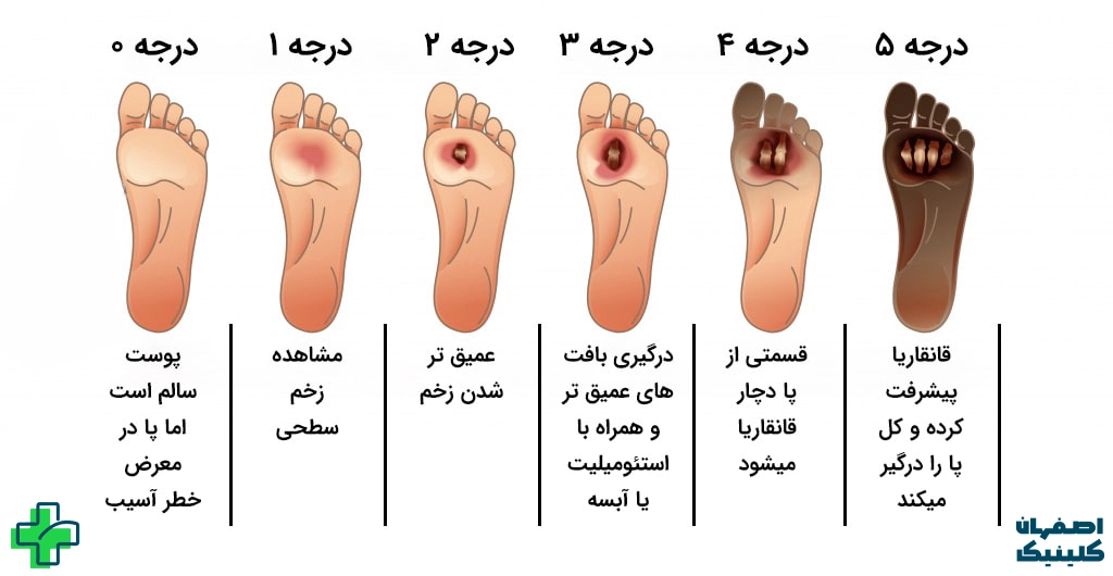 مرکز زخم پای دیابتی اصفهان علائم زخم دیابتی